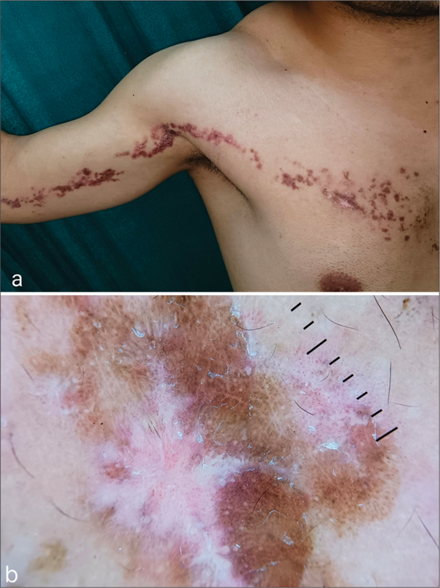 (a) A linear violaceous to brownish plaque with few discrete papules in a blaschkoid pattern extending from the right side of the anterior aspect of the chest to the right arm with an erythematous background and overlying whitish scaling at a few places. (b) Dermoscopic examination showing reticulate whitish structures, white scales and dotted vessels (DL4,10X).