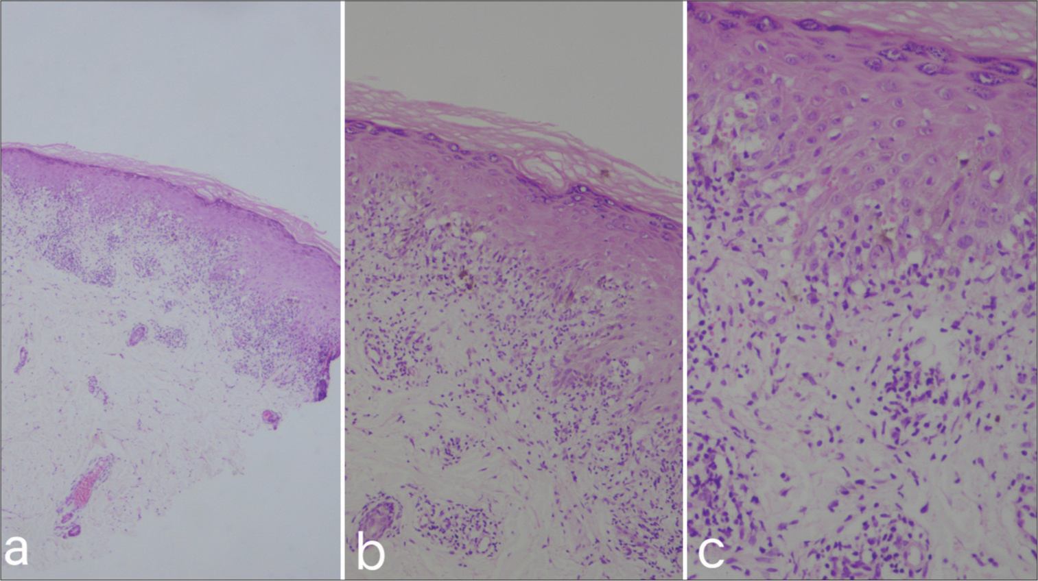 HPE showing (a and b) hyperorthokeratosis, focal hypergranulosis, focal epidermal hyperplasia, vacuolar degeneration of the basal layer, lymphocytic infiltrate at dermo-epidermal junction, and dermal melanophages (×4, ×10, H&E), (c) lymphocytic infiltrate at dermo-epidermal junction, and dermal melanophages (×40, H&E). H&E: Hematoxylin and eosin, HPE: Histopathological examination..