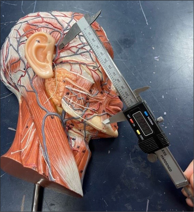 Visualization of anatomical points used for thread implantation trajectory measurement.