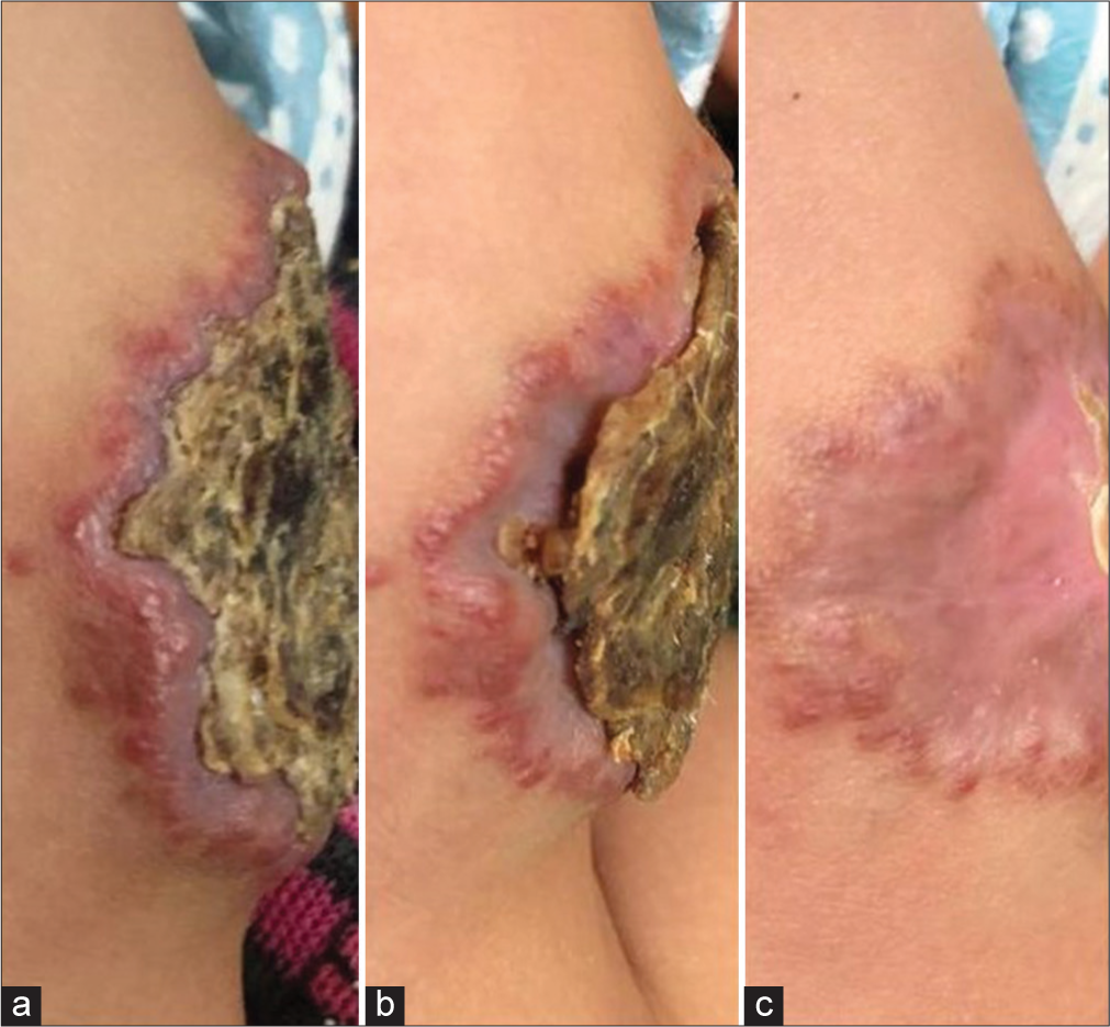 A lateral profile of the plaque showing (a) the edematous rim with well-formed crust on day of presentation, (b) reduction of edema and shrinkage of the crust by day 10 and (c) clear involution with almost flattening of the lesion by one month.