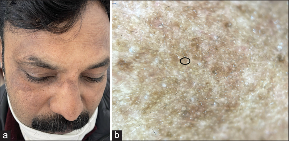 (a) Presence of ill-defined, irregular, brownish patches of pigmentation symmetrically distributed over bilateral sides of forehead, lateral cheeks, nasal bridge and eyebrows in a case of melasma; (b) Dermoscopic examination revealed the presence of reticuloglobular pigment, with few brown dots (black oval), and unfocussed telangiectasia (DermLite DL4; 3Gen; San Juan Capistrano, California, USA, noncontact polarized mode, ×10 magnification).