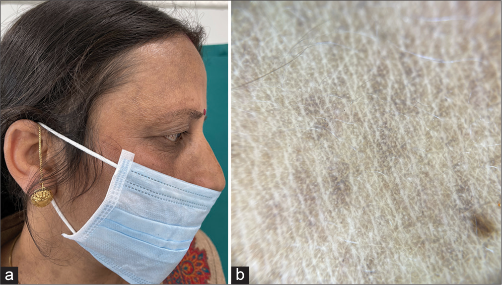 (a) Presence of multiple brown macules over the temples, cheek, nose, and neck in a female with lichen planus pigmentosus; (b) Dermoscopic examination revealed the presence of perieccrine and perifollicular brown pigment globules with peppering distributed in hem-like pattern (DermLite DL4; 3Gen; San Juan Capistrano, California, USA, noncontact polarized mode, ×10 magnification).