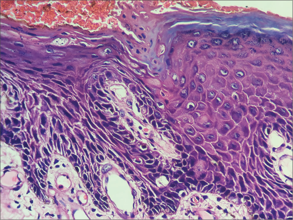 Photomicrograph showing parakeratotic column of cells overlying hypogranulosis (H&E, ×100).