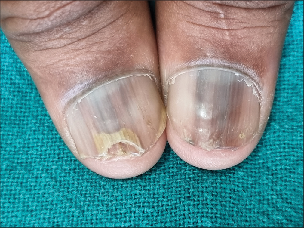 Clinical picture showing melanonychia and distal onycholysis.