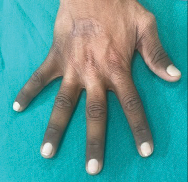 Clinical picture showing nail pallor in all nails.