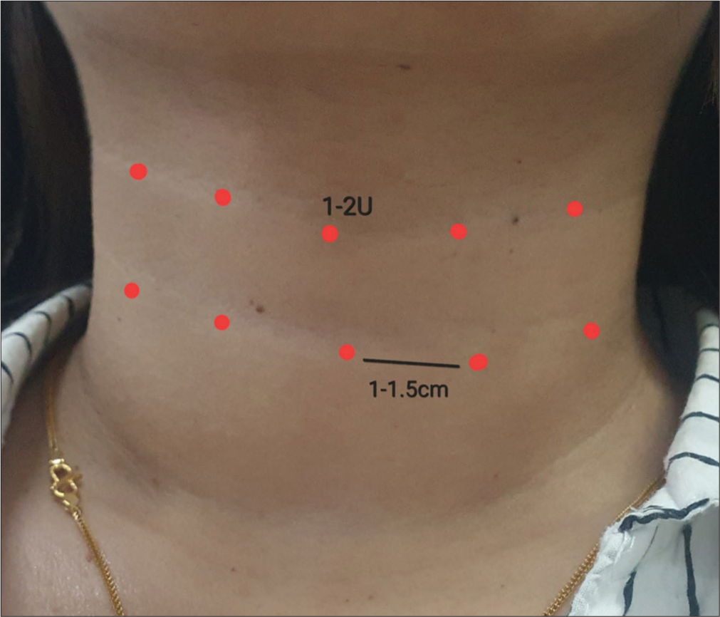 Horizontal neck lines: 1–2 U of botulinum toxin A is injected at 8–10 points (red dots) 1–1.5 cm apart.