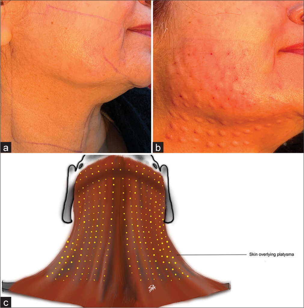 Microbotulinum toxin: (a) Surface marking for platysma on one side, (b) superficial injection blebs visible upon toxin infiltration, and (c) neck with injection points (yellow dots) for reference on the entire neck and inferior border of mandible.