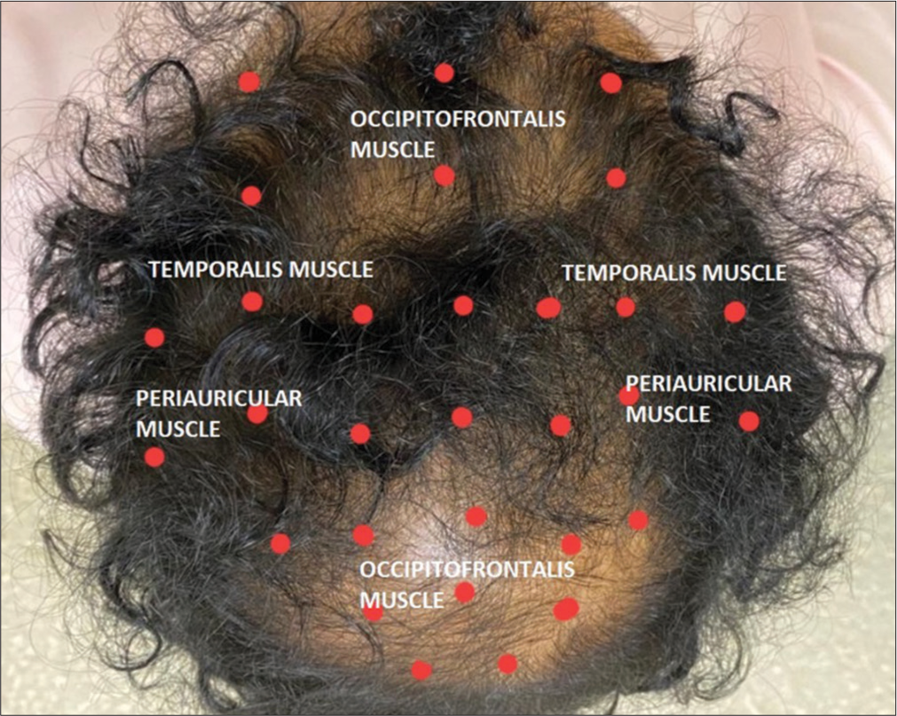 Androgenetic alopecia: 30 points (red dots) to be injected with 5 U of botulinum toxin A at each point. The muscles that are targeted are occipitofrontalis, temporalis, and periauricular muscles.