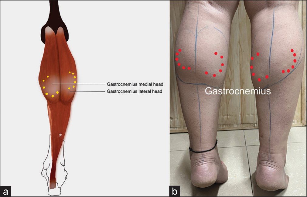 Calf slimming effect: (a) Anatomy of gastrocnemius with injection points (yellow dots) for reference, and (b) three to six intramuscular injections of botulinum toxin A is given 1.5–2 cm apart administered into the most prominent part of gastrocnemius (red dots).