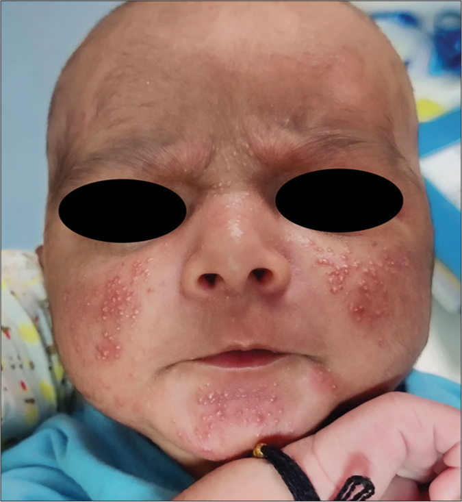 Infantile acne in a 4-month-old infant.