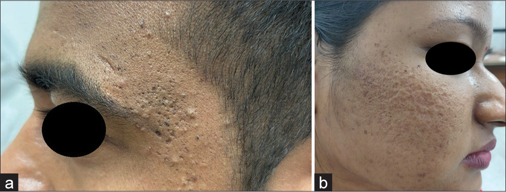 Atrophic acne scars (a) predominantly ice-pick with boxcar scars in a 24-year-old male (b) ice-pick, boxcar, and rolling scars in a 20-year-old female.