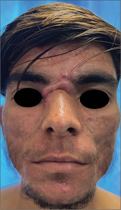 Keloidal acne scar over the root of the nose in a 28-year-old male.