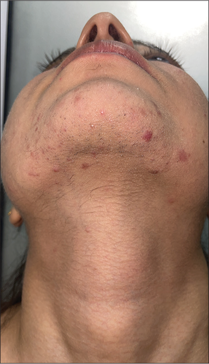 Endocrine/Hormonal acne with hirsutism in a 22-year-old female with polycystic ovarian syndrome.
