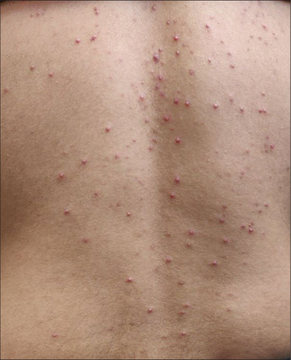 Drug-induced acneiform eruption in a 28-year-old male secondary to anti-tubercular drug presenting as monomorphic erythematous follicular papules over lower back.