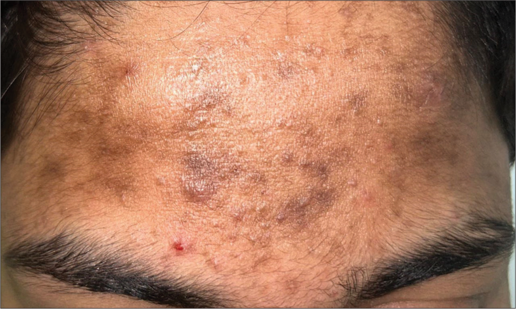 Pomade acne presenting over the forehead in a 25-year-old male.