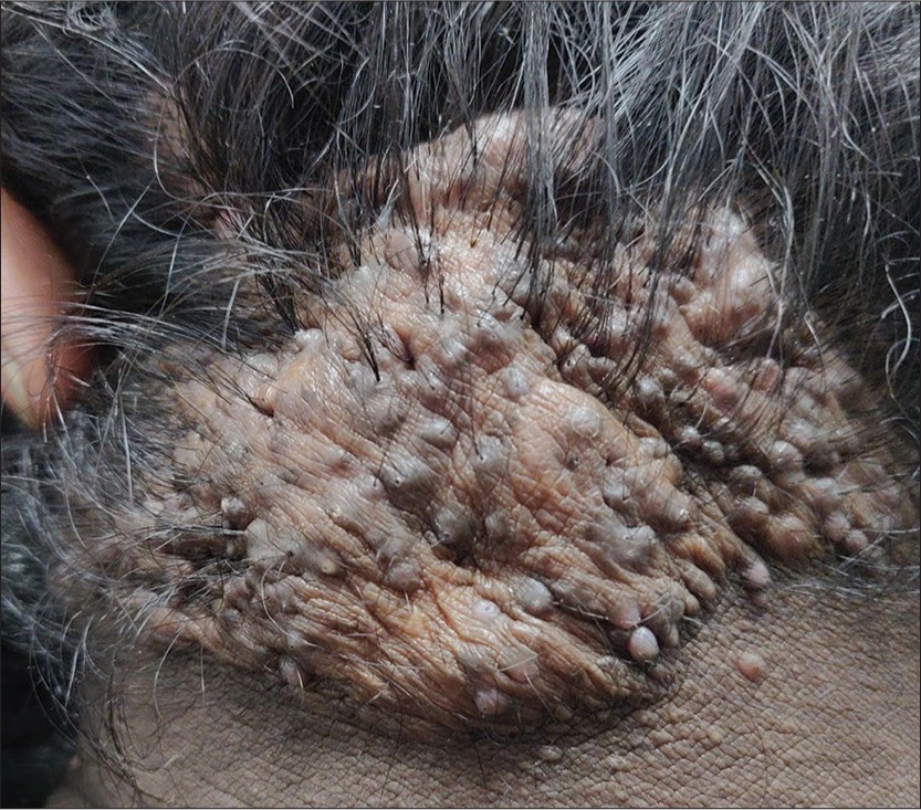 Acne keloidalis nuchae presenting as a large hypertrophic scar with tufted hair over the nape of neck and occipital scalp in a middle-aged man.
