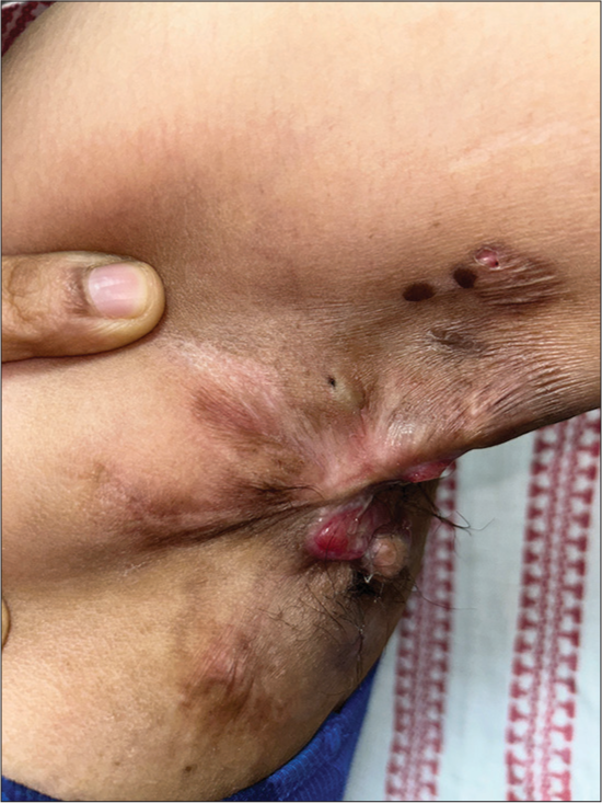 Acne inversa (hidradenitis suppurativa) presenting in a 27-year-old female.