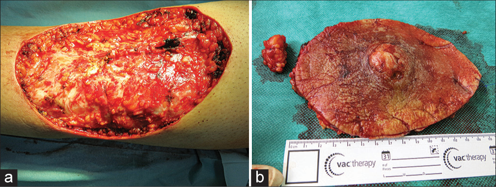 Surgery of the tumor. (a) Surgical defect resulting after wide excision. (b) Surgical specimen of the lesion.