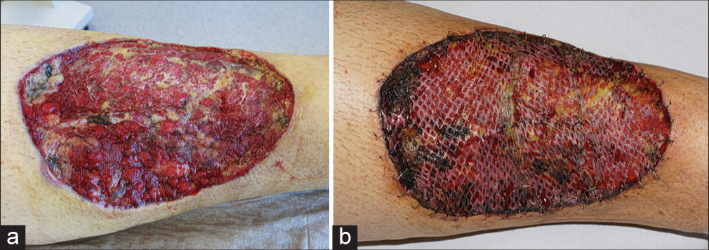 (a) Stimulated granulation of the wound ground by vacuum-assisted closure. (b) Stable meshed split skin graft on the 6th day after surgery.