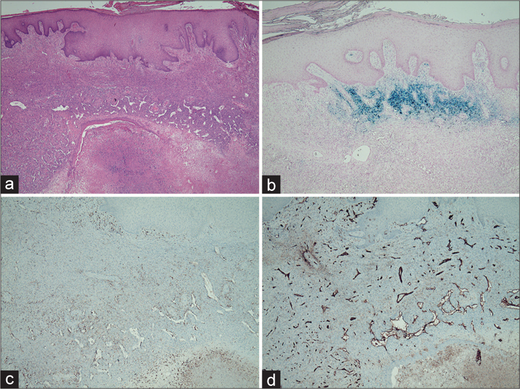 Histopathology of the tumor lesion. (a) Cellular fibrous histiocytoma with a storiform pattern covered by acanthotic epidermis. On the bottom is a necrotic area where the remnants of an epidermal cyst are still visible (Hematoxylin and Eosin ×2). (b) Iron staining (×4). (c) Positive immunostaining for CD68 (×4) mostly in the periphery. (d) Positive immunostaining for CD31 in the vascular endothelium (×4).