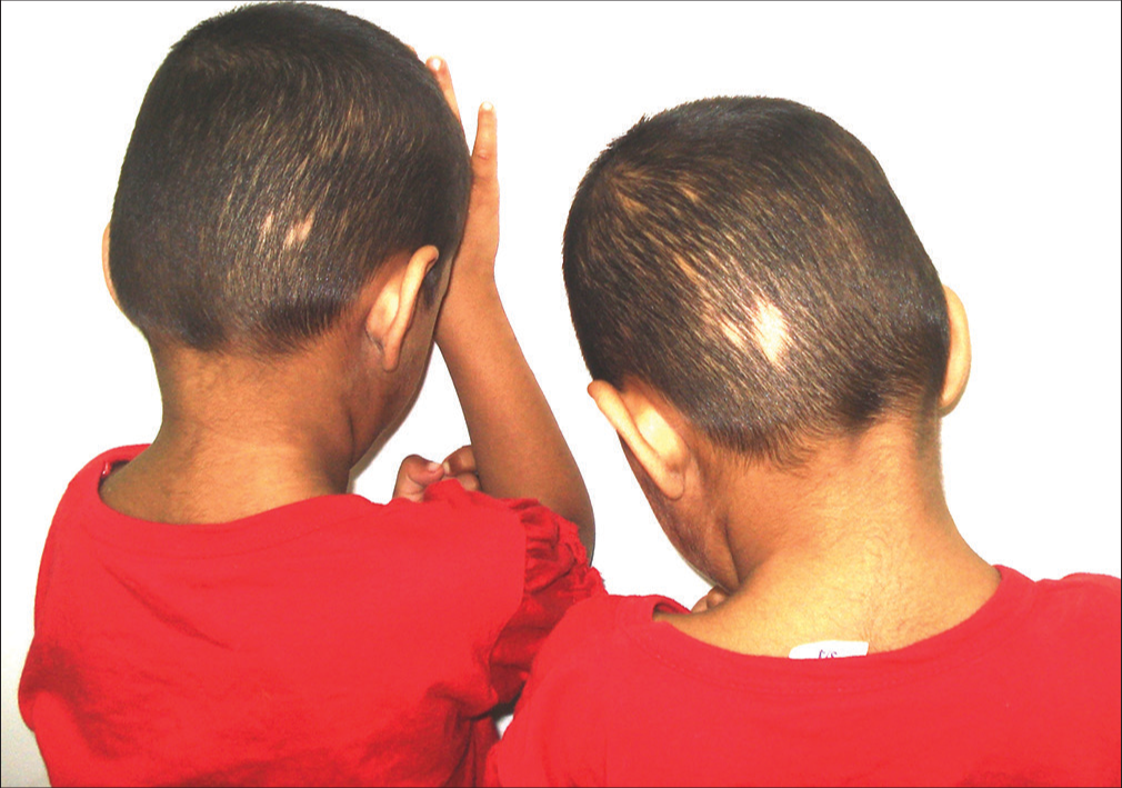 Mirror-image alopecia areata on the occipital scalp of twins.