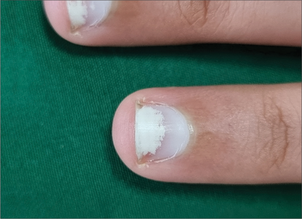 Pseudoleukonychia or keratin degranulation seen after prolonged nail polish application and removal.
