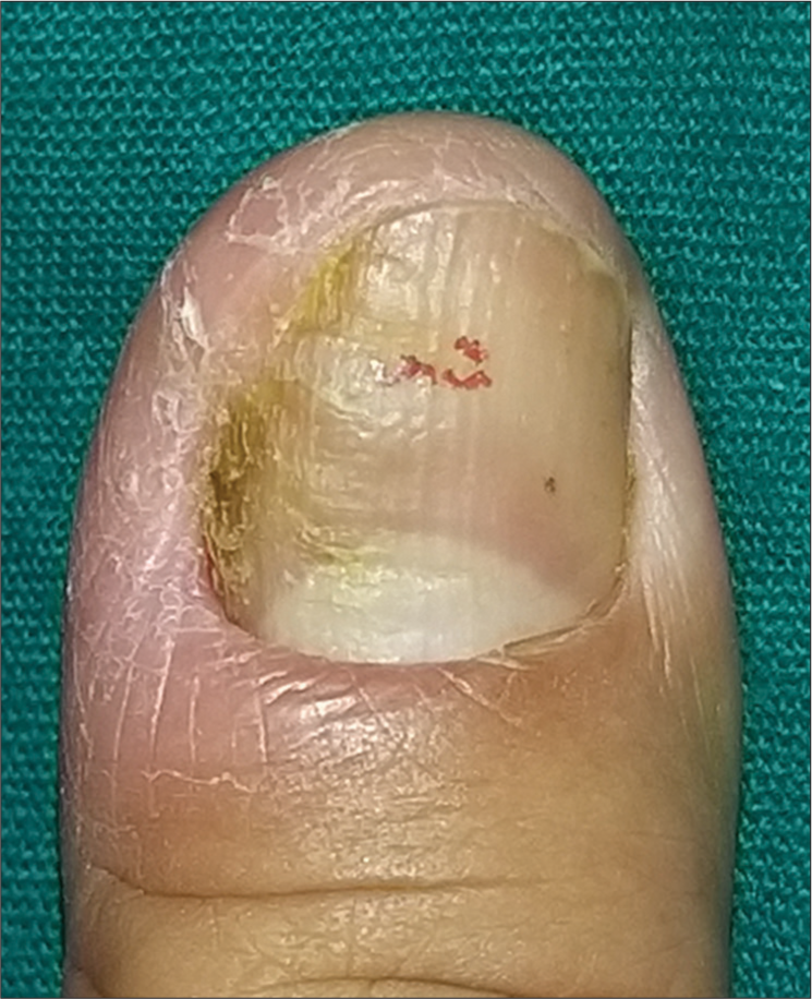 Contact allergic dermatitis involving the periungual area, due to nail polish (ROAT or Repeat Open application Test done). Chronic paronychia with greenish discoloration (chloronychia) can also be seen.