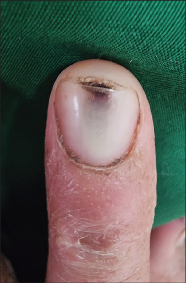 Traumatic nail dystrophy due to removal of nail tips.