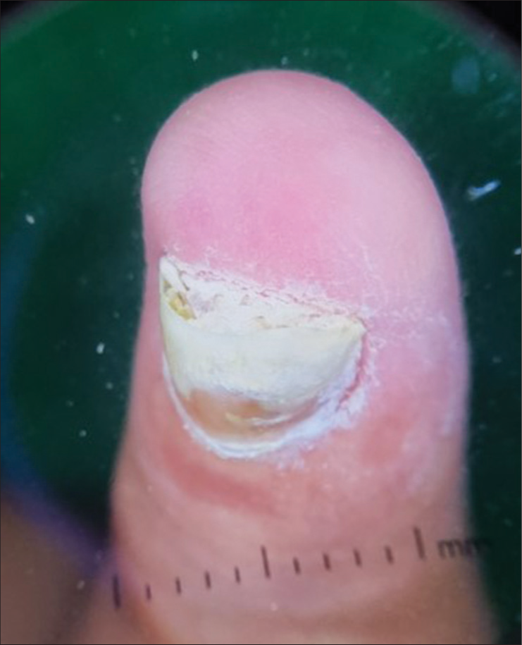 Pseudo-psoriatic nail as seen on onychoscopy. The patient was not a known case of psoriasis. The onset of nail changes was seen after the usage of artificial nails (Dermlite DL4 Polarized ×10).