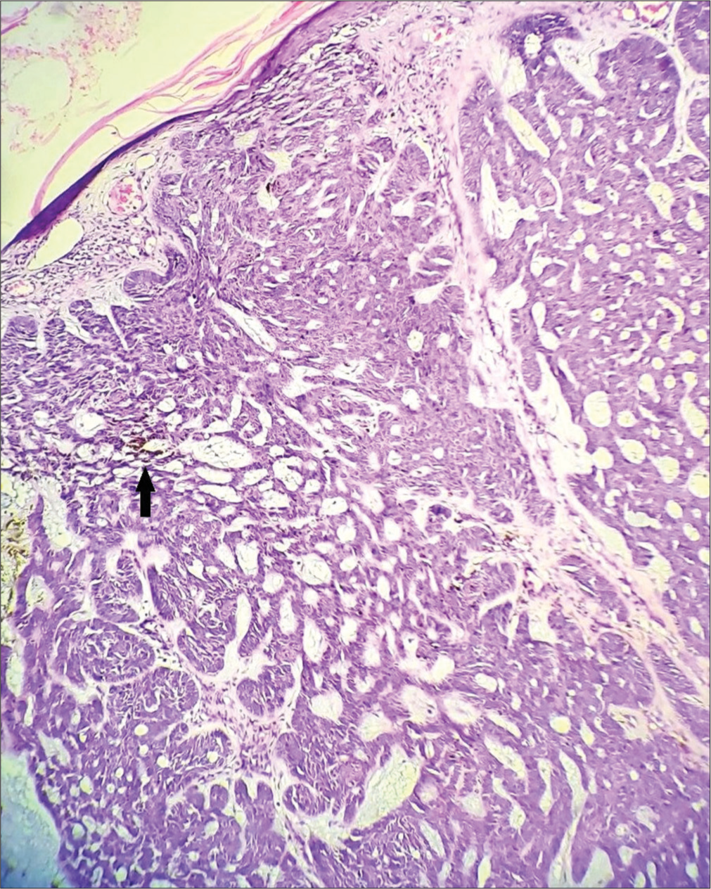 Islands of basaloid tumor cells in the dermis with melanin deposits (arrow), H & E × 100.