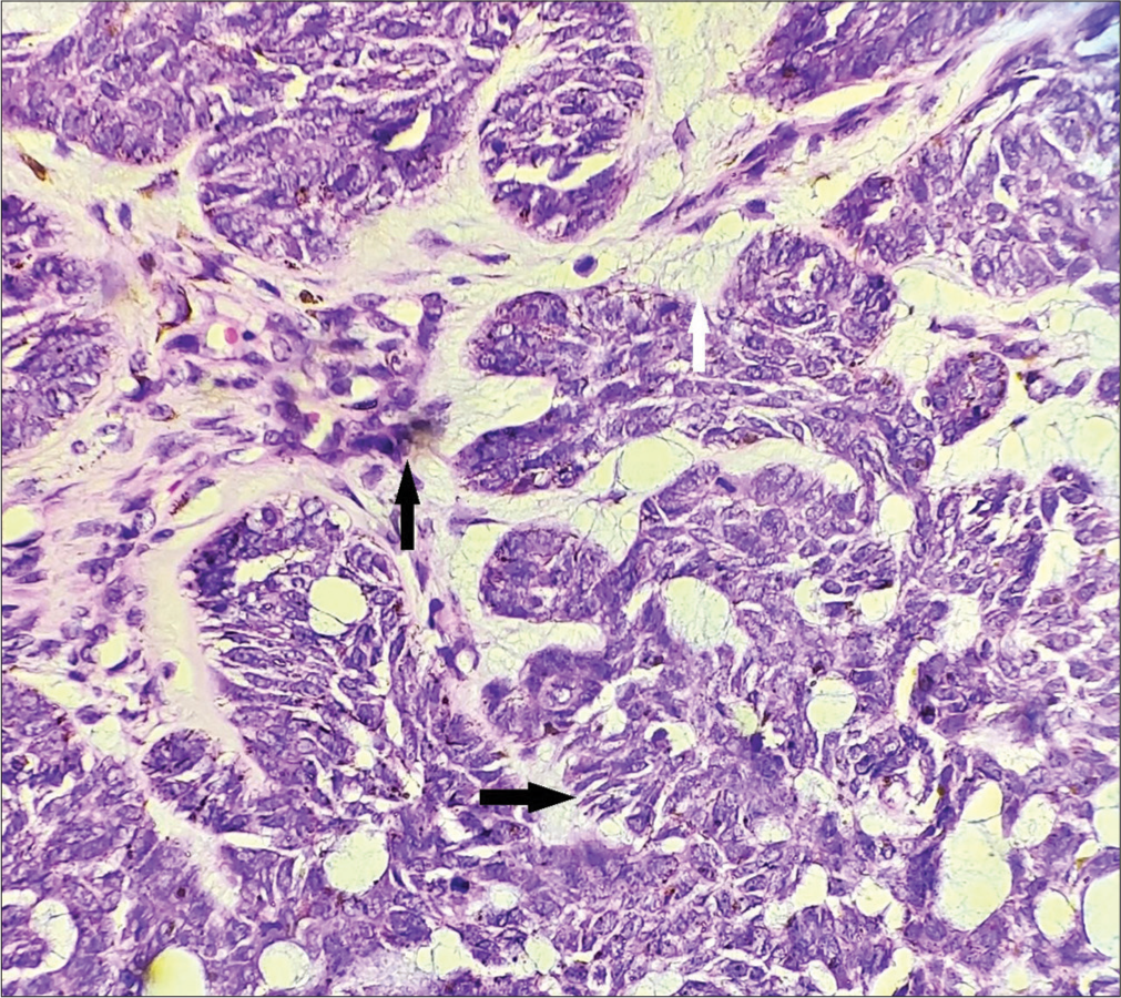 Basaloid tumor islands showing peripheral palisading of nuclei (horizontal black arrow), melanin deposits (vertical black arrow), and intervening stroma (vertical white arrow), H&E × 400.
