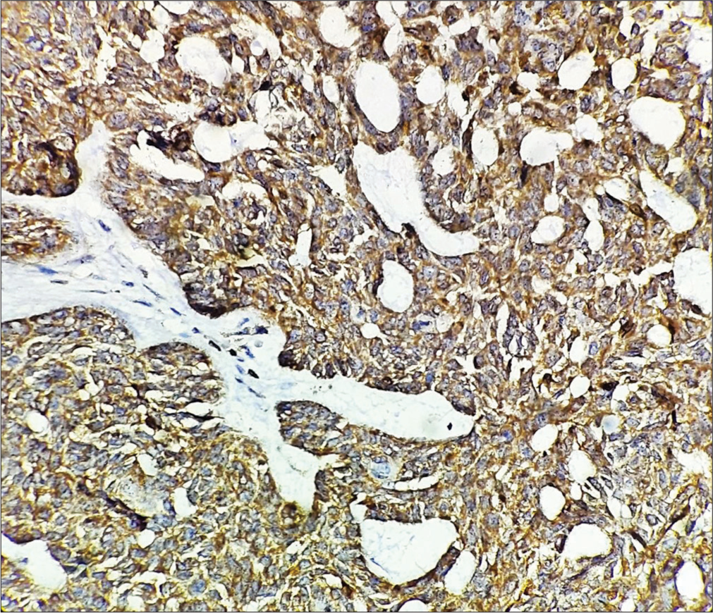 Immunohistochemistry showing tumor cells to be positive for Bcl-2, Immunohistochemistry stain × 400.