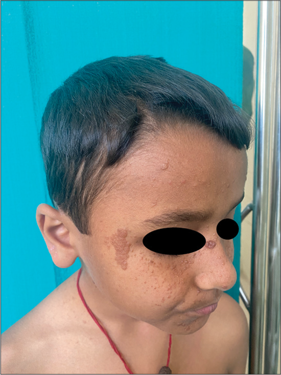 Fibrous cephalic plaque over the right temple region with multiple angiofibromas over the right side of the face.