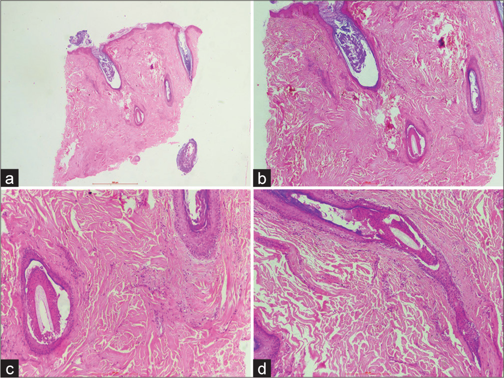 (a) Skin biopsy shows basket-weave orthokeratosis with the presence of keratotic plugs. (H&E; ×20) (b) The dermis shows irregularly arranged thick bundles of reticular collagen bundles (H&E; ×40), (c) The involvement of hair follicles leads to perifollicular fibrosis (H&E; ×100), (d) The hair follicles are distorted due to irregularly thickened collagen (H&E; ×100).