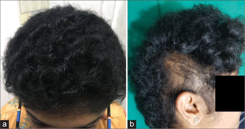 (a) Three months after treatment with minoxidil. (b) One year later, patchy loss of hair on the right side due to trichotillomania, good hair growth in other areas.