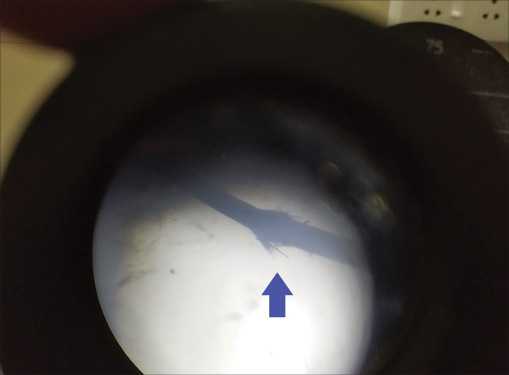 Light microscopy showing “Splayed paint brush bristle” appearance (blue arrows).