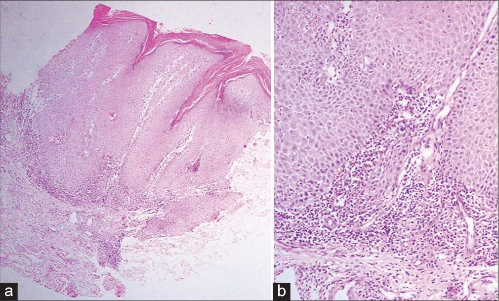 (a) Histopathological image of the plaque on the right side showing shows verrucous hyperplasia of the epidermis and a band-like infiltrate at the dermoepidermal junction (hematoxylin and eosin ×40). (b) Higher magnification of the histopathological image of dermoepidermal junction showing basal layer vacuolization, mild pigment incontinence, and a moderate degree of chronic inflammatory infiltrate in the upper dermis (hematoxylin and eosin ×200).