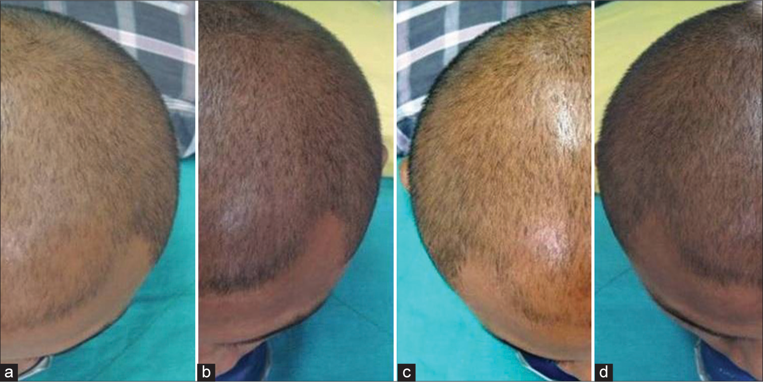 Global photography comparing scalp hair at baseline (a and c) and at fourth month (b and d).