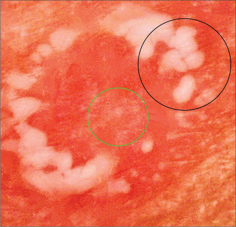 Dermoscopic examination in polarized mode (AM7115MZT Dino-Lite Edge 3.0 digital microscope) at ×30 magnification showing uniform red dotted vessels against an erythematous backdrop (green circle), encircled by clustered, white pustules arranged discretely as well as in both annular and polycyclic configurations (black circle).