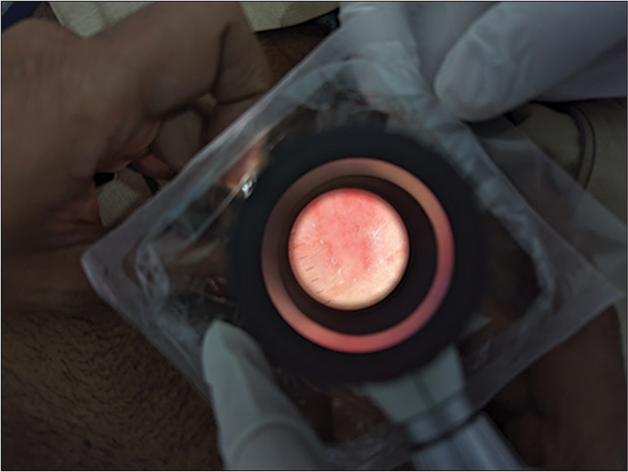 Dermatoscopy of a genital lesion using single-use disposable plastic cover as a sterile interface.
