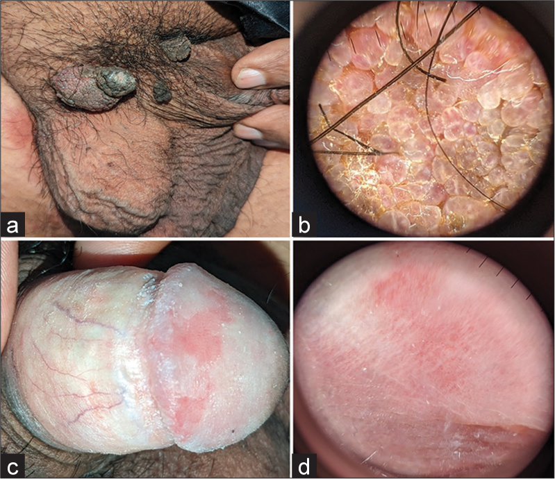 Some examples of genital dermatoscopy using plastic materials as interface (a) genital warts, (b) corresponding dermatoscopic image showing lobules with red linear and lacunar vessels suggestive of warts, (c) erosive genital lichen sclerosus et atrophicus, and (d) corresponding dermatoscopy showing ill-defined white areas with red dotted and thin linear vessels.