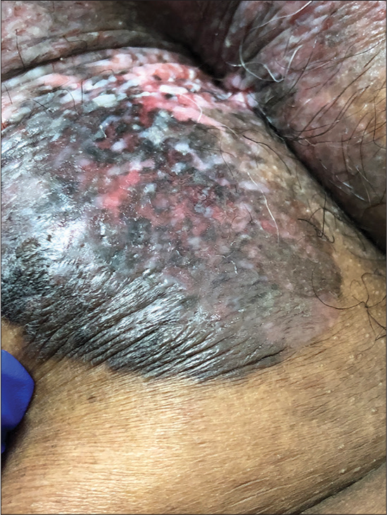 Erythematous, hyperpigmented plaque with well-demarcated but irregular edges in the perianal region.