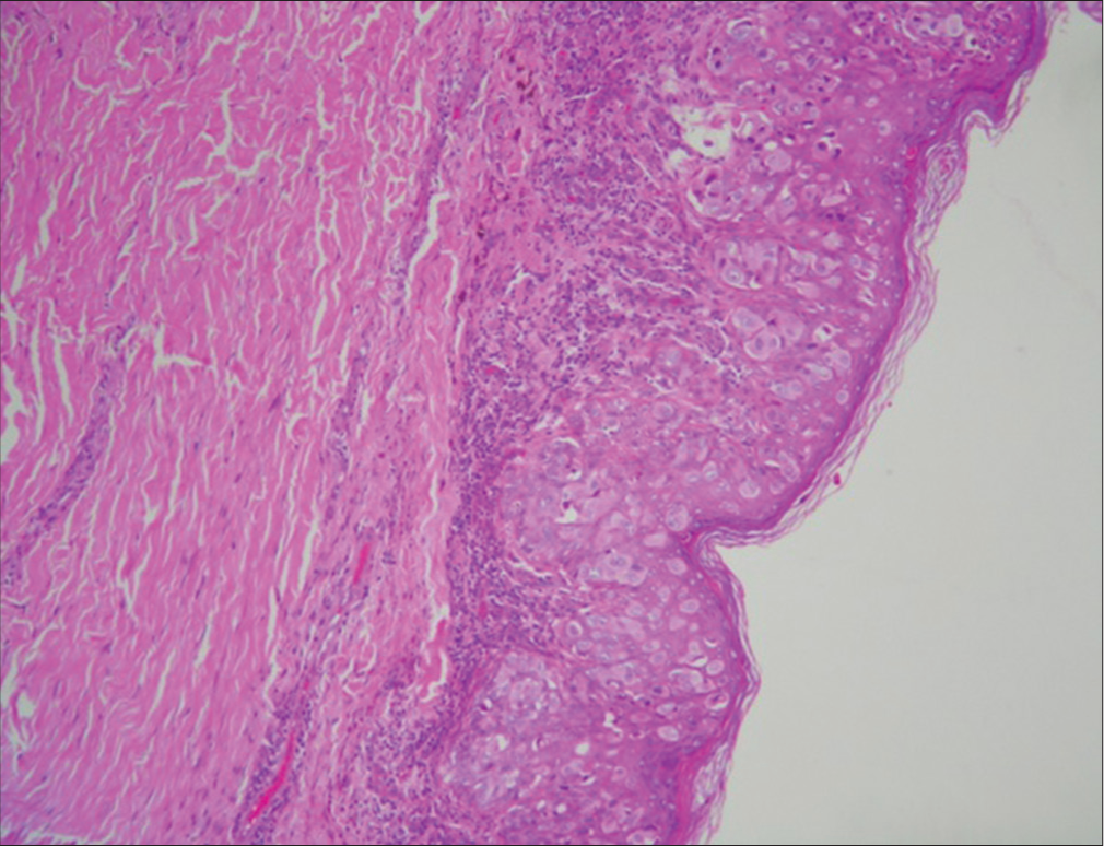 Hematoxylin and eosin, ×40 invasion of the epidermis by pagetoid cells.
