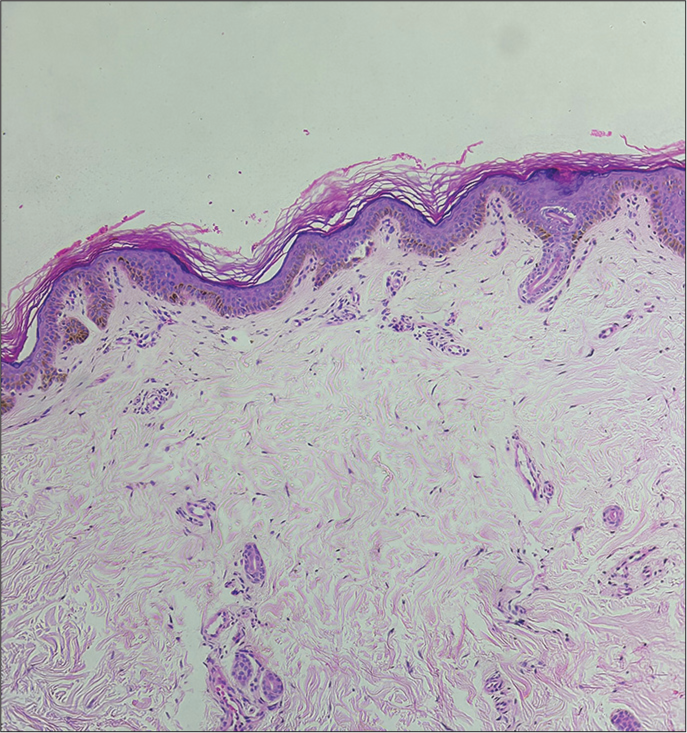 Mild-to-moderate perivascular lymphohistiocytic infiltrate and pigment incontinence in the upper dermis (H&E; ×40).