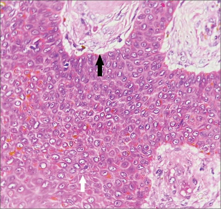 Small cells with clear cytoplasm and tiny basophilic nuclei (white arrow) and tubular lumina filled with colloid material (black arrow), H&E ×400.