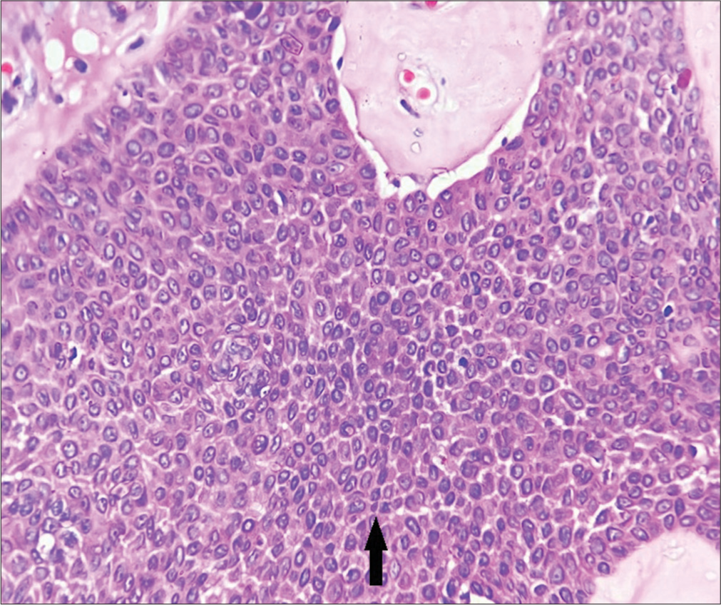 Fusiform cells with basophilic cytoplasm (arrow), H&E ×400.