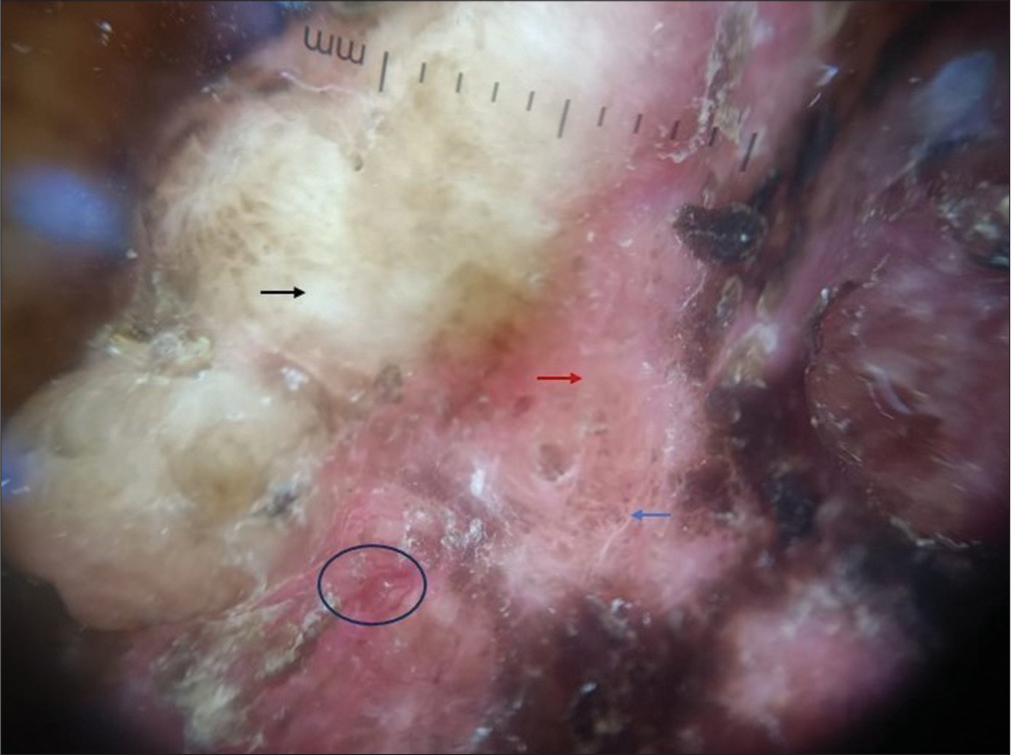 Polarized dermoscopy showed a white homogenous area (black arrow), brown pigment in the periphery (blue arrow), red-brown homogenous area (red arrow), and linear vessels (black circle).