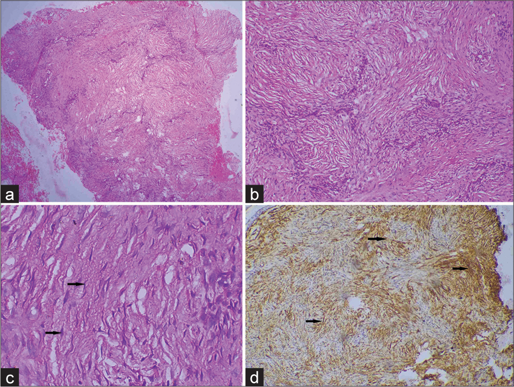 (a) Scanner view showing interlacing cords of spindle cells involving the entire dermis and subcutis (H&E, × 40), (b) storiform pattern of spindle cells in the deep dermis (H&E, × 100), (c) dermal fibroblast cell (black arrow) (H&E, × 400), and (d) immunohistochemistry (IHC) showing tumor cells densely positive for CD 34 marker (black arrow) (IHC stain × 400).