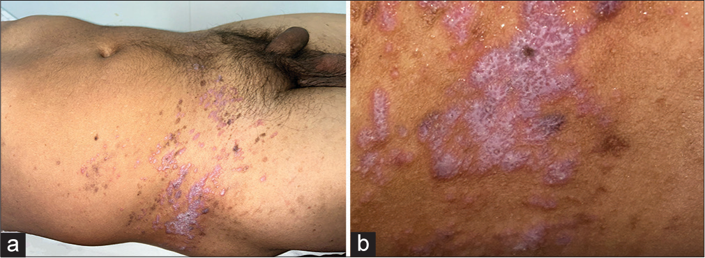 (a) Violaceous, polygonal, pruritic papules, and coalescent plaques along with brown atrophic papules in a zosteriform distribution involving the right T12-S1 dermatome, extending from the lower lateral back to the inguinal area. (b) A closer examination showing multiple Wickham striae.
