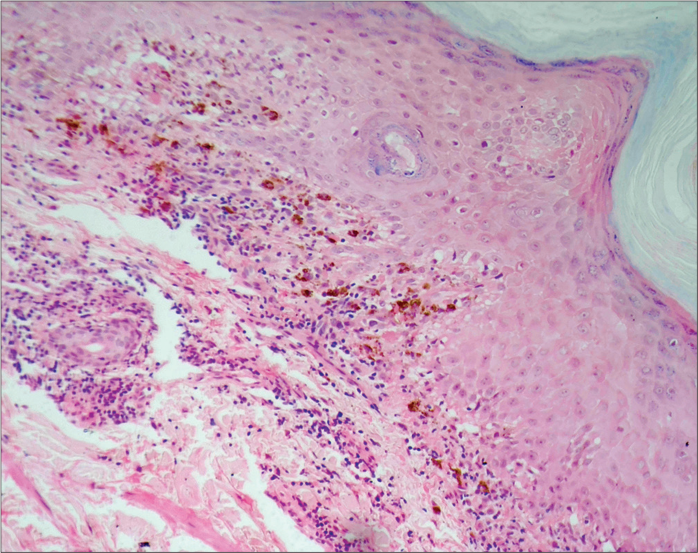 Mild hypergranulosis and band-like lymphocytic infiltrates in the papillary dermis, with colloid bodies and significant pigment incontinence (H and E; ×10).